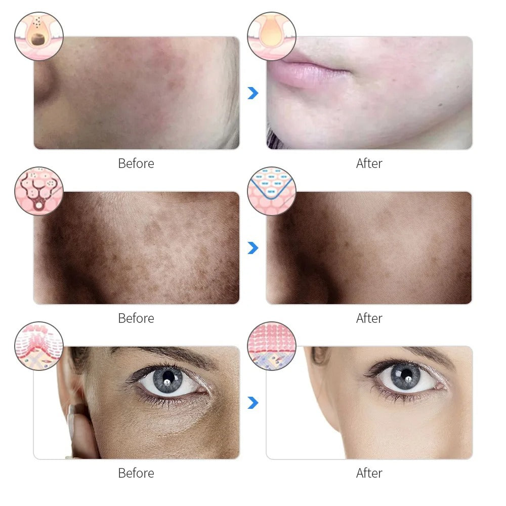 LumaSkin LED Face Mask