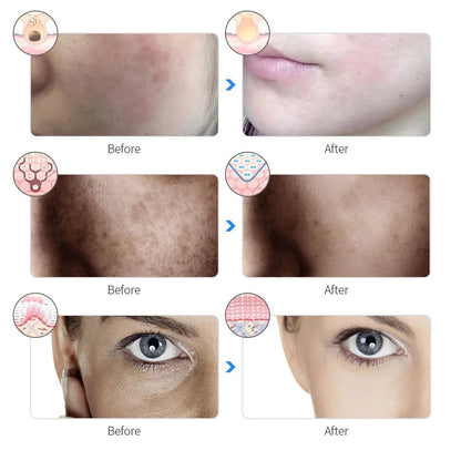 LumaSkin LED Face Mask